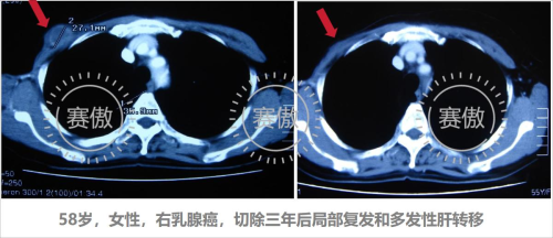 赛傲生命许万鹏引领干细胞与免疫细胞应用革命，治愈众多危重患者